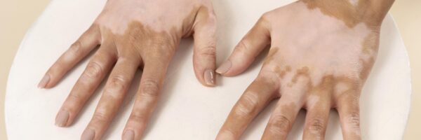 Skin Cancer Clinic Pennant Hills & Surrounds